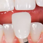 installation of porcelain quickly-The mouth and teeth's health
