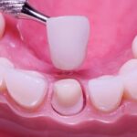 Zirconium crowns-The mouth and teeth's health