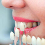 Porcelain laminate-The mouth and teeth's health