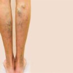 Varicose veins treatment